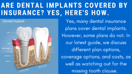 dental insurance coverage for implants Niche Utama Home Yes, Dental Implants Are Covered By Insurance. Here